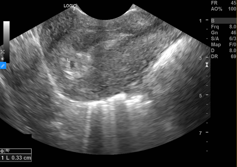 Siêu âm thai nhi 2 tuần tuổi được không? 3