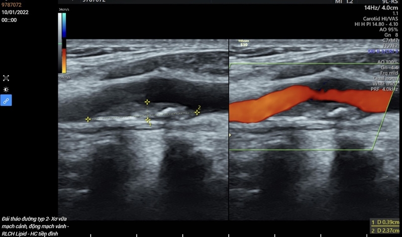 Siêu âm tĩnh mạch chi dưới, khi nào nên thực hiện? 1