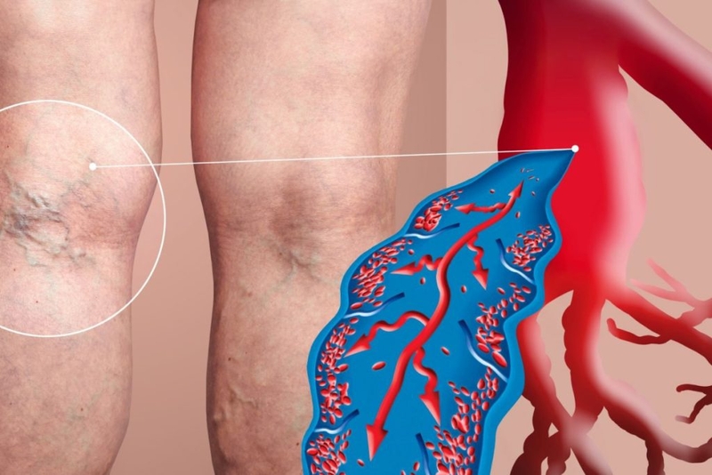 Siêu âm tĩnh mạch chi dưới, khi nào nên thực hiện? 3