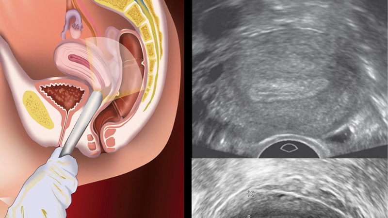 Siêu âm trực tràng và những điều cần biết 2