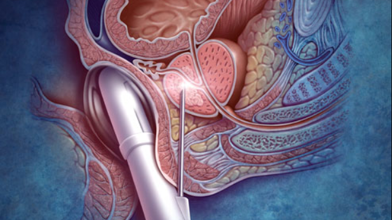 Siêu âm trực tràng và những điều cần biết 1