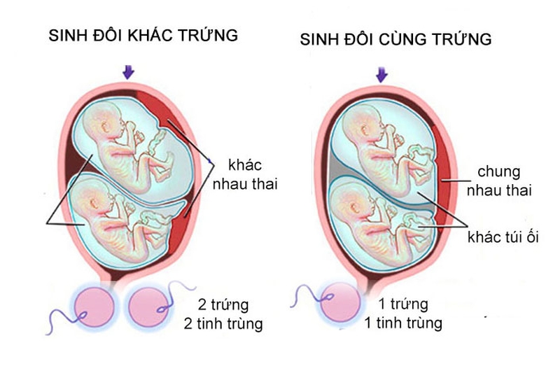 Sinh đôi khác trứng là gì? Tại sao lại có hiện tượng sinh đôi khác trứng? 3