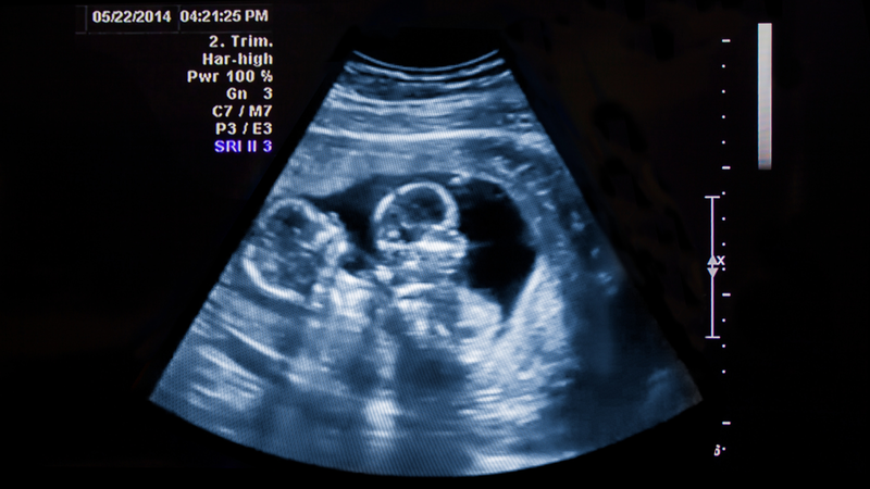 Thai sinh đôi có dùng chung nhau thai và túi ối không?