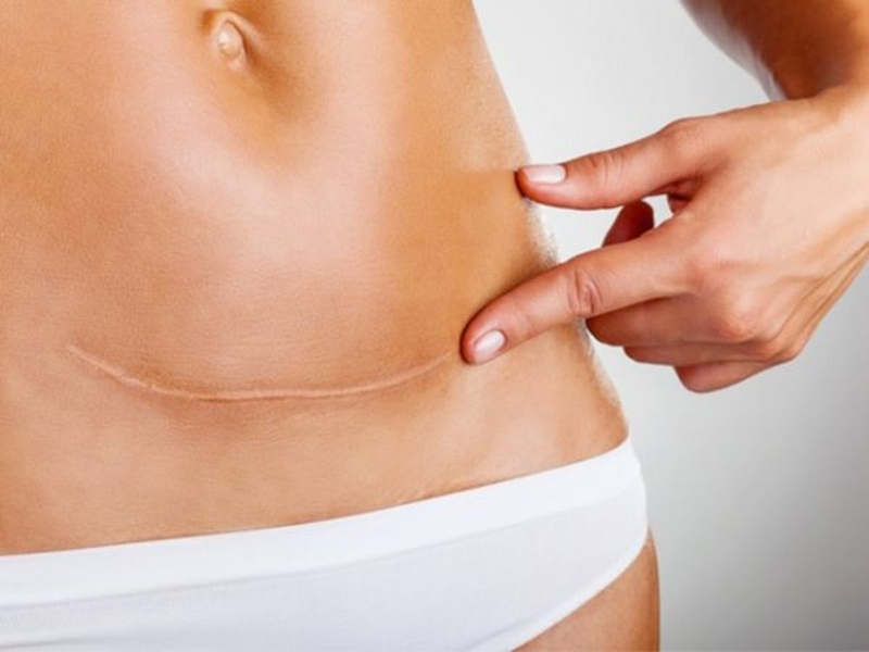 Sinh mổ bao lâu thì ăn được thịt gà? -2