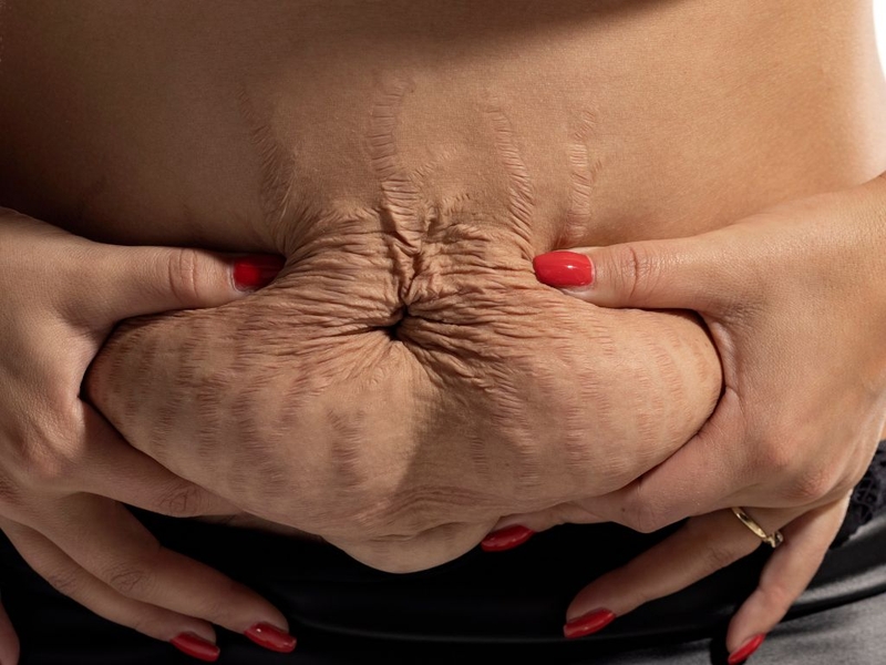 Sinh mổ bao lâu thì nịt bụng được? Cách sử dụng nịt bụng sau sinh mổ đúng cách 1