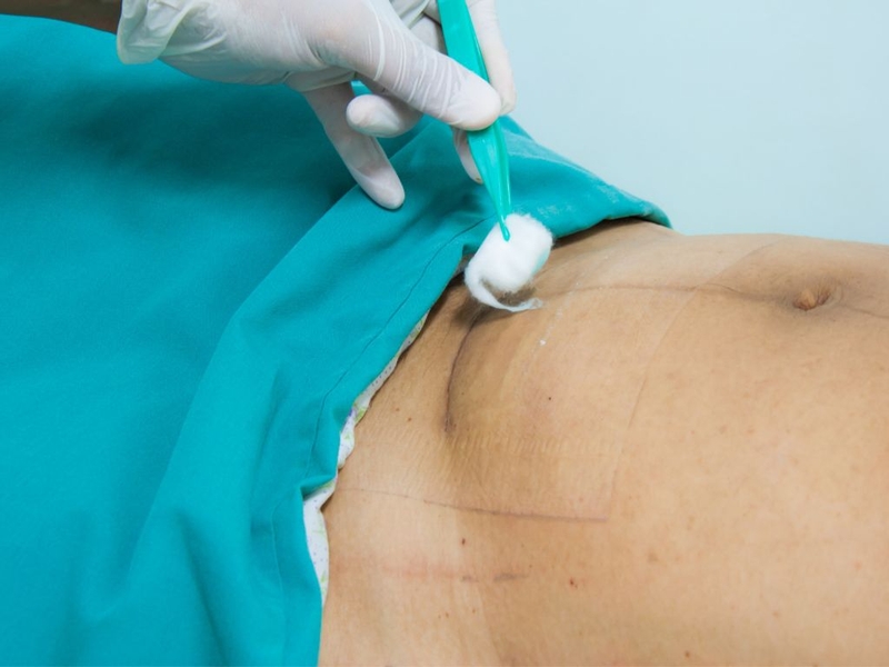 Sinh mổ bao lâu thì nịt bụng được? Cách sử dụng nịt bụng sau sinh mổ đúng cách 2