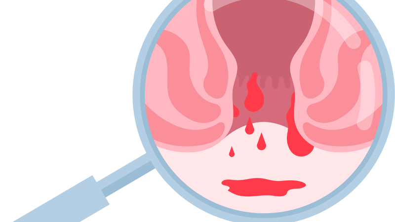 Sinh mổ có bị băng huyết không? Nguyên nhân và cách phòng ngừa 5