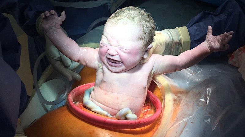 Sinh mổ là gì? Những điều cần biết về quá trình mổ lấy thai 1