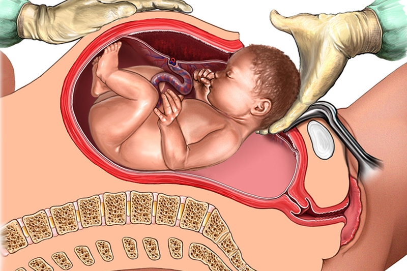 Sinh mổ lần 3 có nguy hiểm không? Những điều cần lưu ý khi sinh mổ lần 3 3