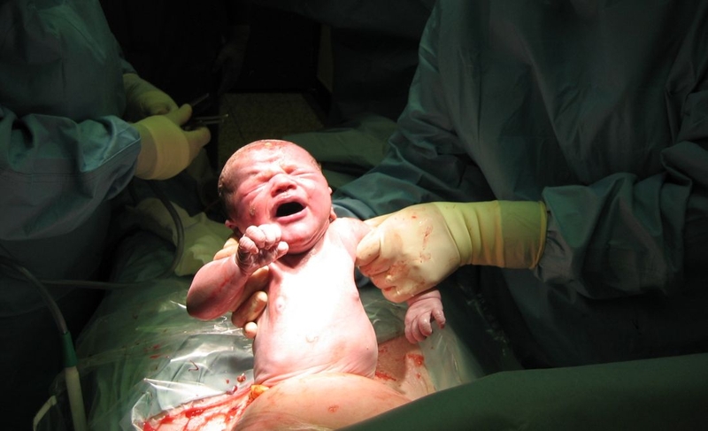 Sinh mổ lần 3 mổ dọc hay ngang? So sánh mổ dọc và mổ ngang 1