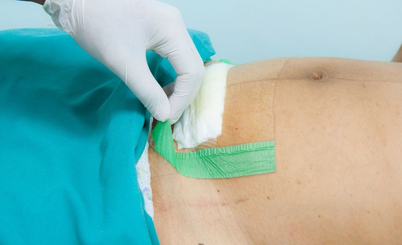 Sinh mổ lần 3 mổ dọc hay ngang? So sánh mổ dọc và mổ ngang 2