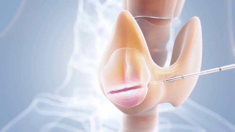 Sinh thiết bướu cổ - phương pháp xác định bướu giáp lành tính hay ung thư 2