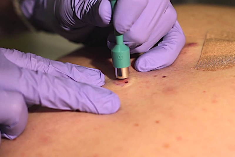 Sinh thiết da là gì? Sinh thiết da bao lâu có kết quả? 2