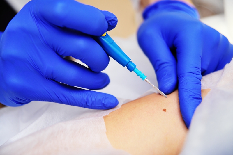 Sinh thiết da là gì? Sinh thiết da bao lâu có kết quả? 1