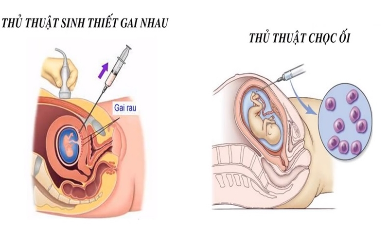 Sinh thiết gai nhau là gì? Những lưu ý quan trọng khi thực hiện 1