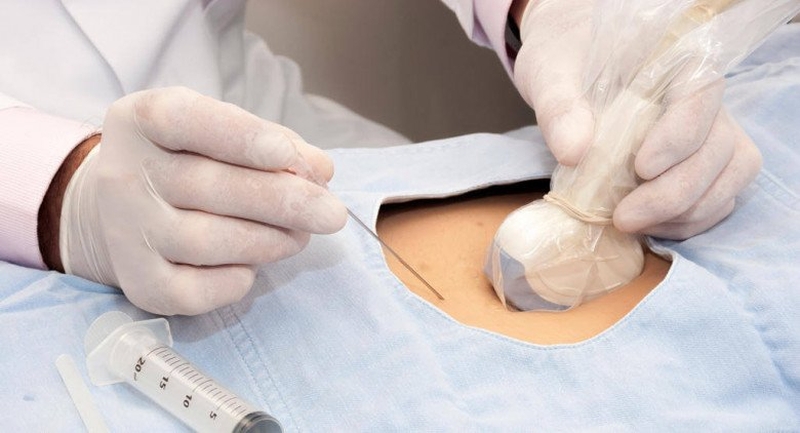 Sinh thiết gai nhau là gì? Những lưu ý quan trọng khi thực hiện 2