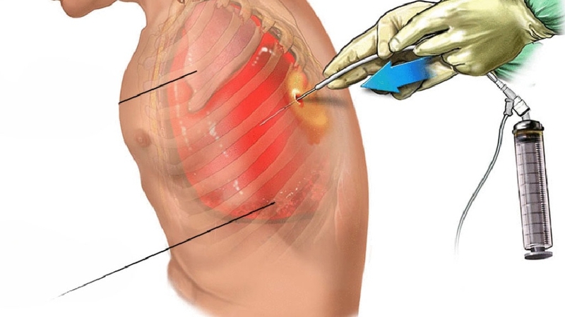 Sinh thiết màng phổi mù: Khái niệm, chỉ định và quy trình thực hiện 1