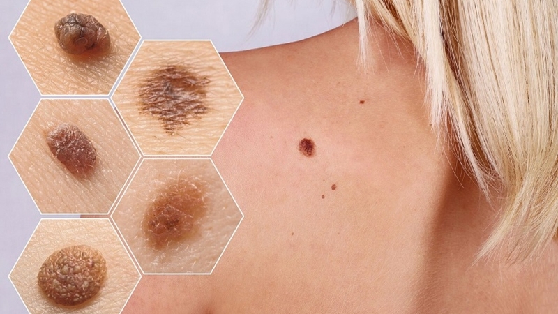 Ung thư hắc tố da là gì? Sinh thiết nốt ruồi và phân biệt nốt ruồi ác tính 1