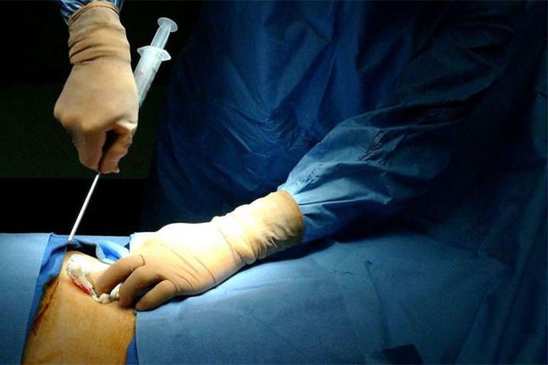 Chọc hút tủy xương hoặc sinh thiết tủy xương dưới gây mê3