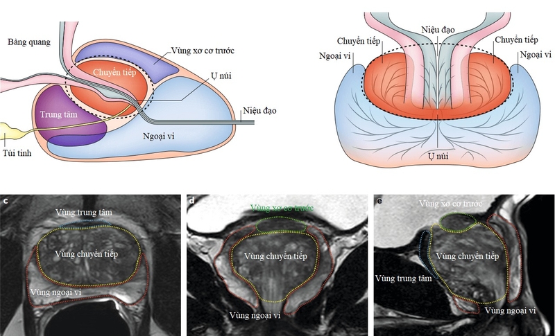 Sinh thiết tuyến tiền liệt qua hướng dẫn của siêu âm kết hợp MRI thực hiện khi nào? 2