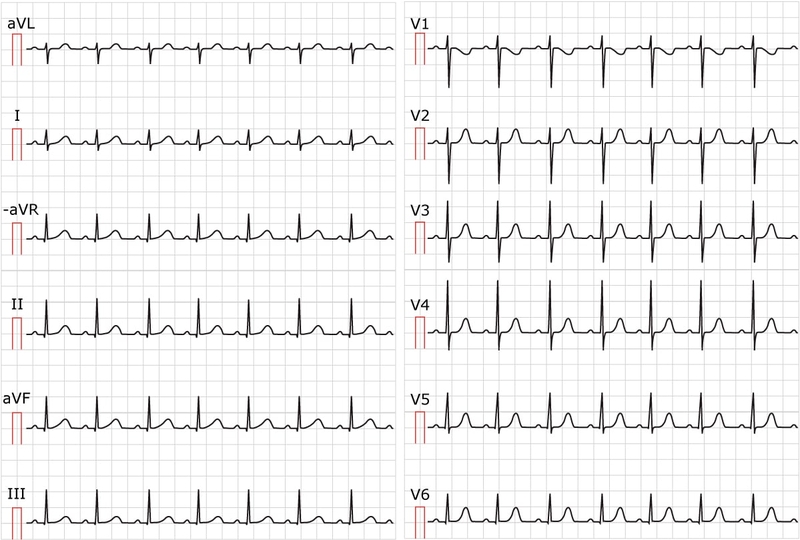 Sinus tachycardia là gì? Có nguy hiểm không? 1