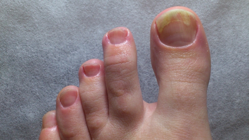 Móng chân bị gợn sóng có phải là dấu hiệu nguy hiểm