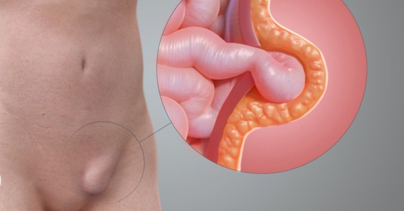 Mổ thoát vị bẹn có nguy hiểm không? Các phương pháp điều trị cho bệnh nhân 2