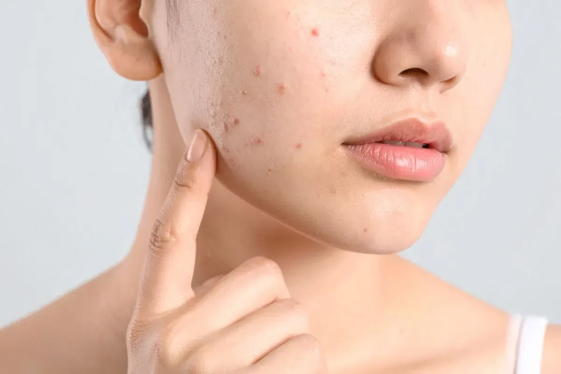Mụn ẩn là loại mụn hình thành nhân sâu dưới da