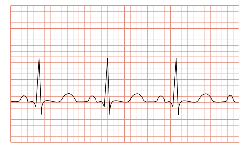 Cách đọc điện tâm đồ như thế nào là câu hỏi thắc mắc của nhiều người