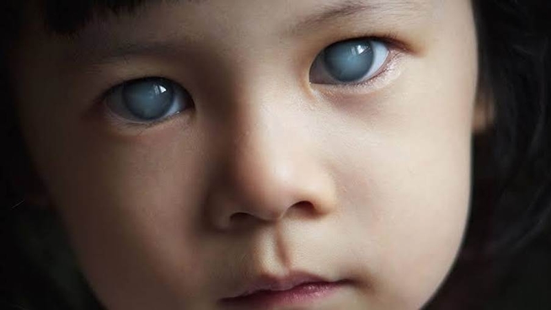 Hội chứng Sturge-Weber là gì? Nguyên nhân, triệu chứng và cách điều trị 4