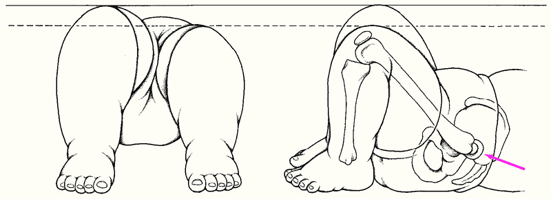 Loạn sản khớp háng có nguy hiểm không?