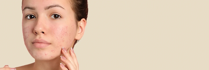 Phác đồ điều trị mụn chuẩn y khoa được Bác sĩ da liễu sử dụng-1