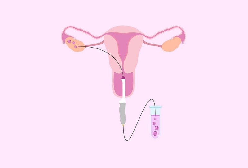 Phụ nữ sau chọc hút trứng bao lâu thì buồng trứng hồi phục? Biện pháp chăm sóc sau thủ thuật 1