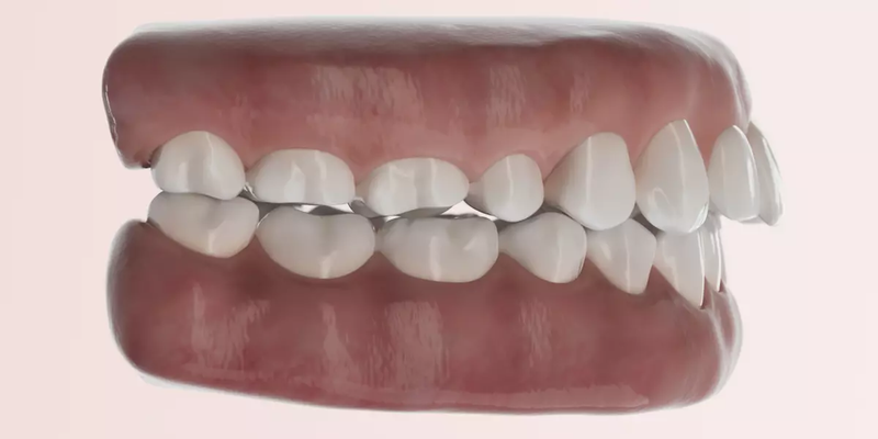 Răng hô nhẹ: Nguyên nhân, tác hại và phương pháp khắc phục 2