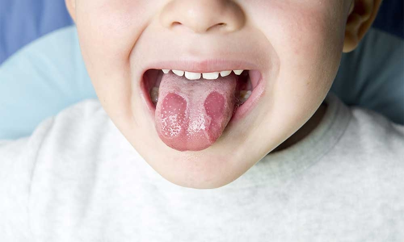 Viêm lưỡi bản đồ là gì? Những vấn đề cần biết về Viêm lưỡi bản đồ1.jpg