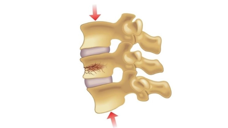 Xẹp đốt sống lưng D12 và những điều cần biết về bệnh 1