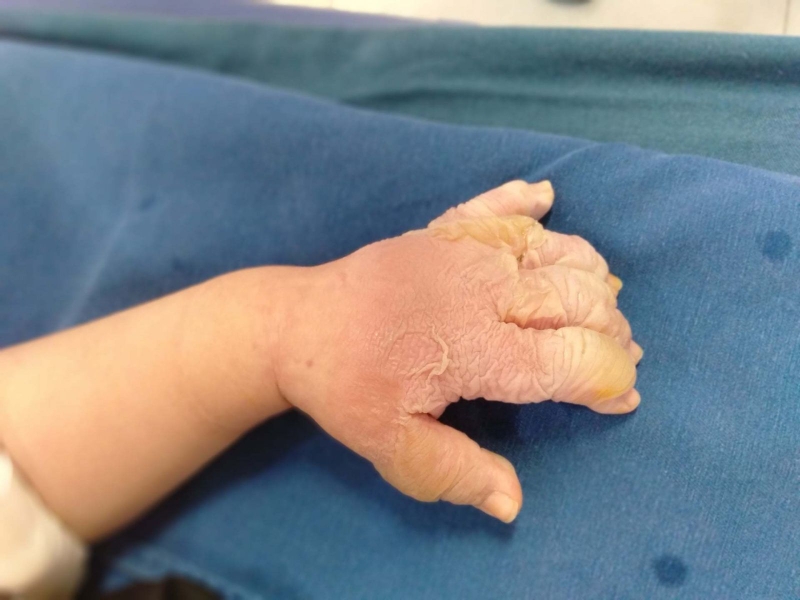 Sơ cứu bệnh bỏng và những điều bạn không thể bỏ qua 1