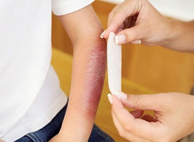 Sơ cứu bỏng đúng cách nhất như thế nào? 1