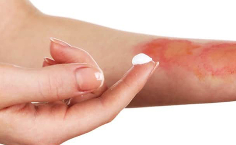 Sơ cứu bỏng bằng kem đánh răng có thực sự hiệu quả? - Nhà thuốc FPT Long Châu