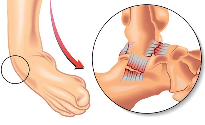 Cách sơ cứu bong gân cổ chân đúng cách 2
