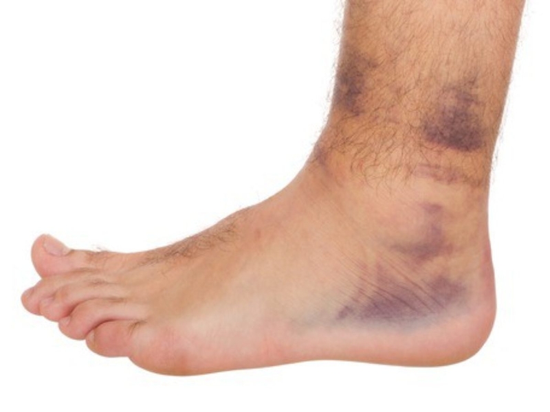 Sơ cứu bong gân cổ chân tại nhà nhanh khỏi2