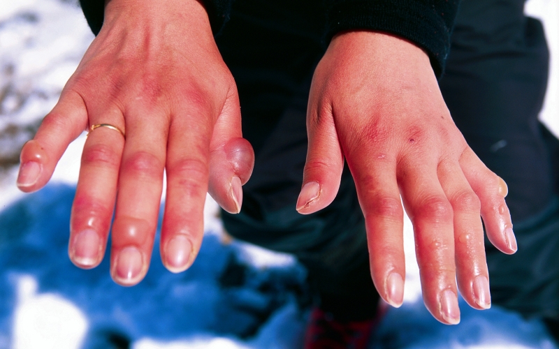 Sơ cứu bỏng lạnh và những thông tin bạn không nên bỏ qua 2