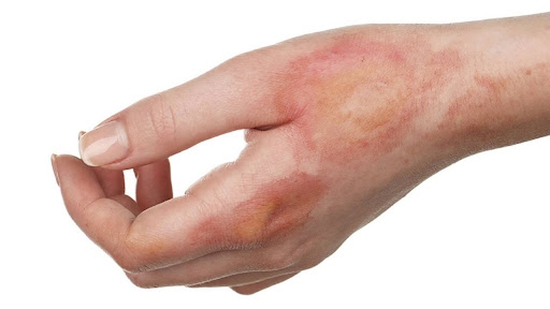 Những chia sẻ về sơ cứu bỏng nước sôi tại nhà hữu ích cho bạn