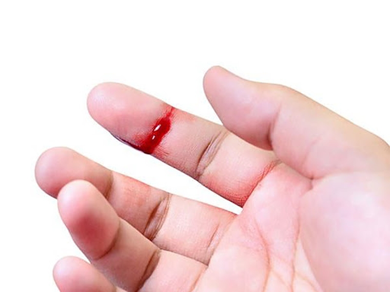 Những kiến thức về sơ cứu cầm máu mà bạn cần biết 1