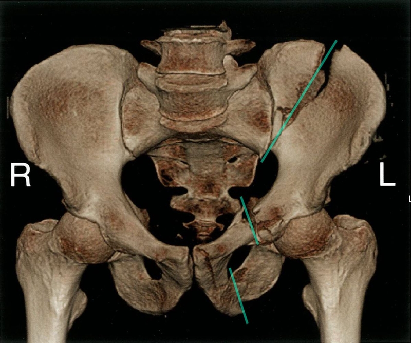 Phương pháp sơ cứu gãy xương chậu đúng cách 1