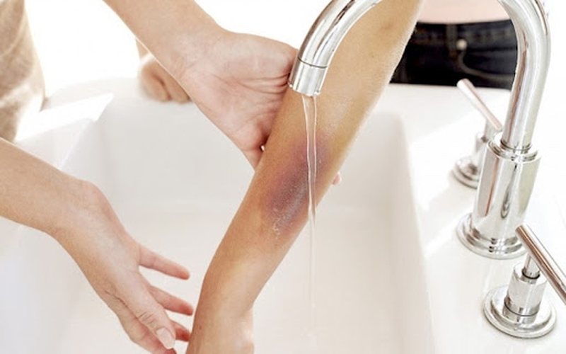 Mách bạn cách sơ cứu khi bé bị bỏng chuẩn nhất 3