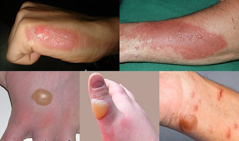 Sơ cứu khi bị bỏng bàn ủi 1