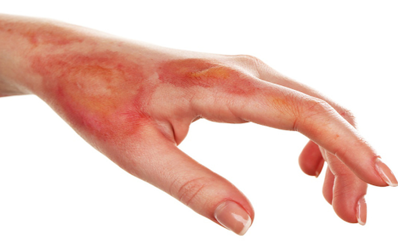 Các cách sơ cứu khi bị bỏng nặng đúng cách mà bạn nên biết 2