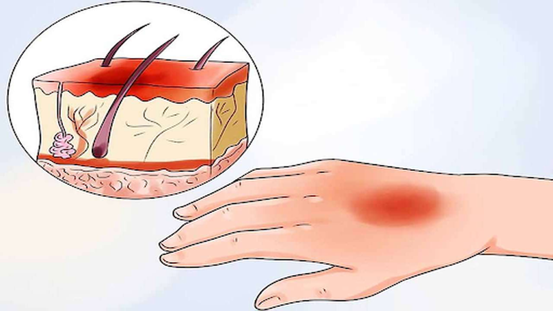 Cách sơ cứu khi bị bỏng vôi bột đúng cách 2