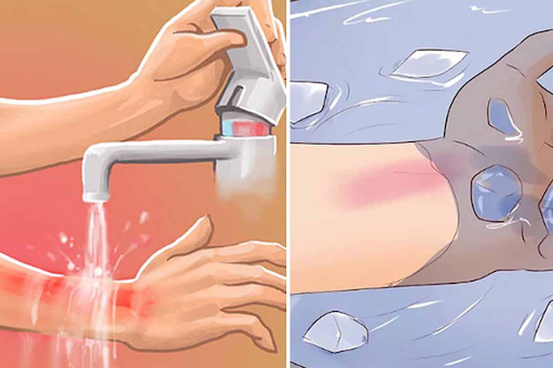 Cách sơ cứu khi bị bỏng vôi bột đúng cách 3